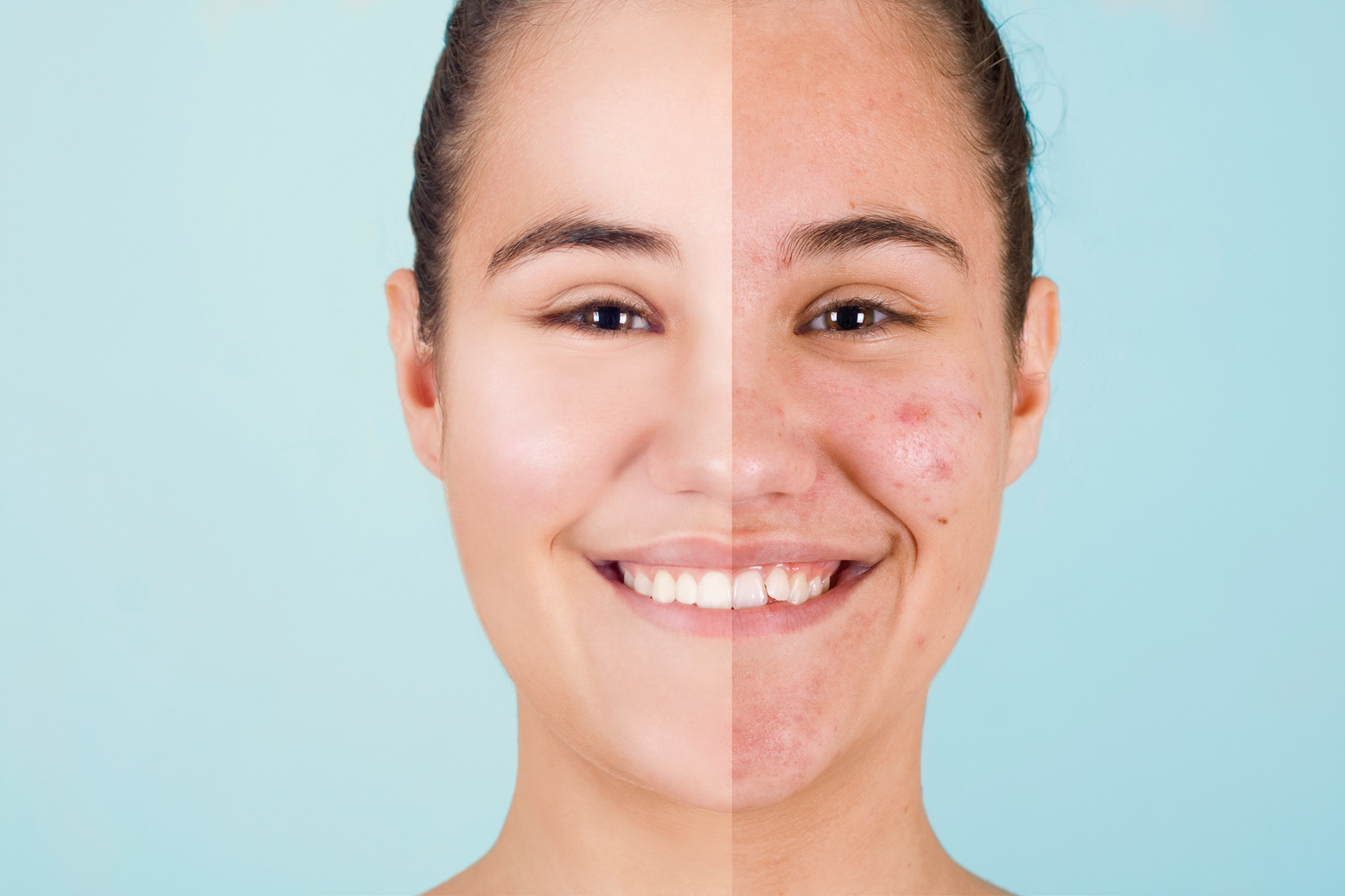 Acne before and after